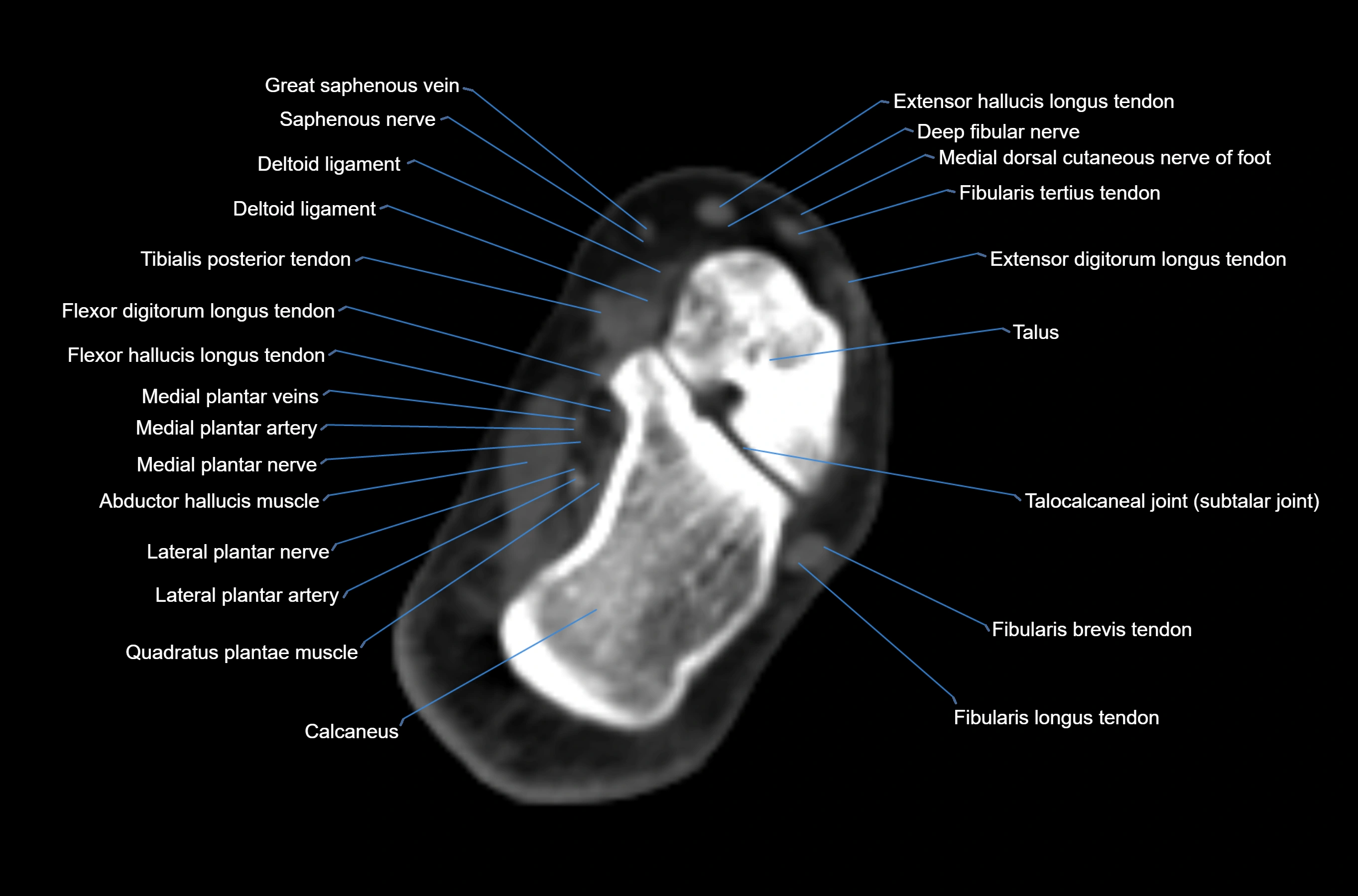 CT Ankle axial cross sectional anatomy labelled image -00038.webp